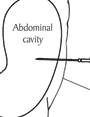 A catheter in the abdomen
